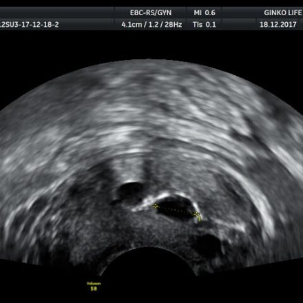 Ultrazvuk male karlice